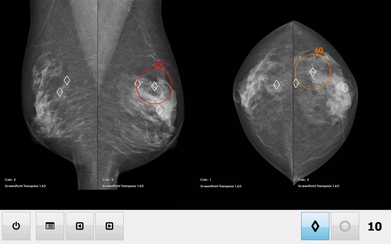 Radiological image of a breast
