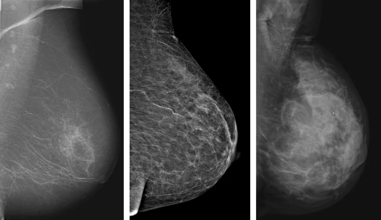 Radiologicimage of different types breast density. Photo